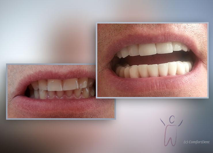 Dental veneers from porcelain