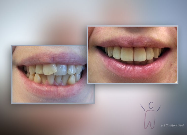 Pirms un pēc zobu protezēšanas