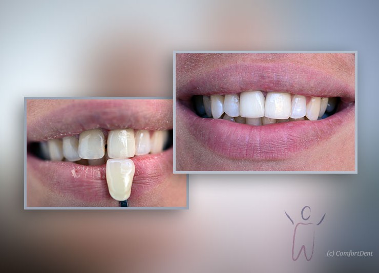 Fixed Prosthodontics with Porcelain Veneers